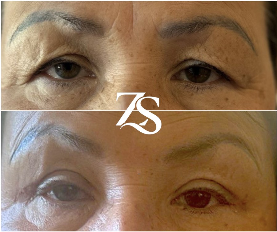 Bilateral Upper Lid Blepharoplasty