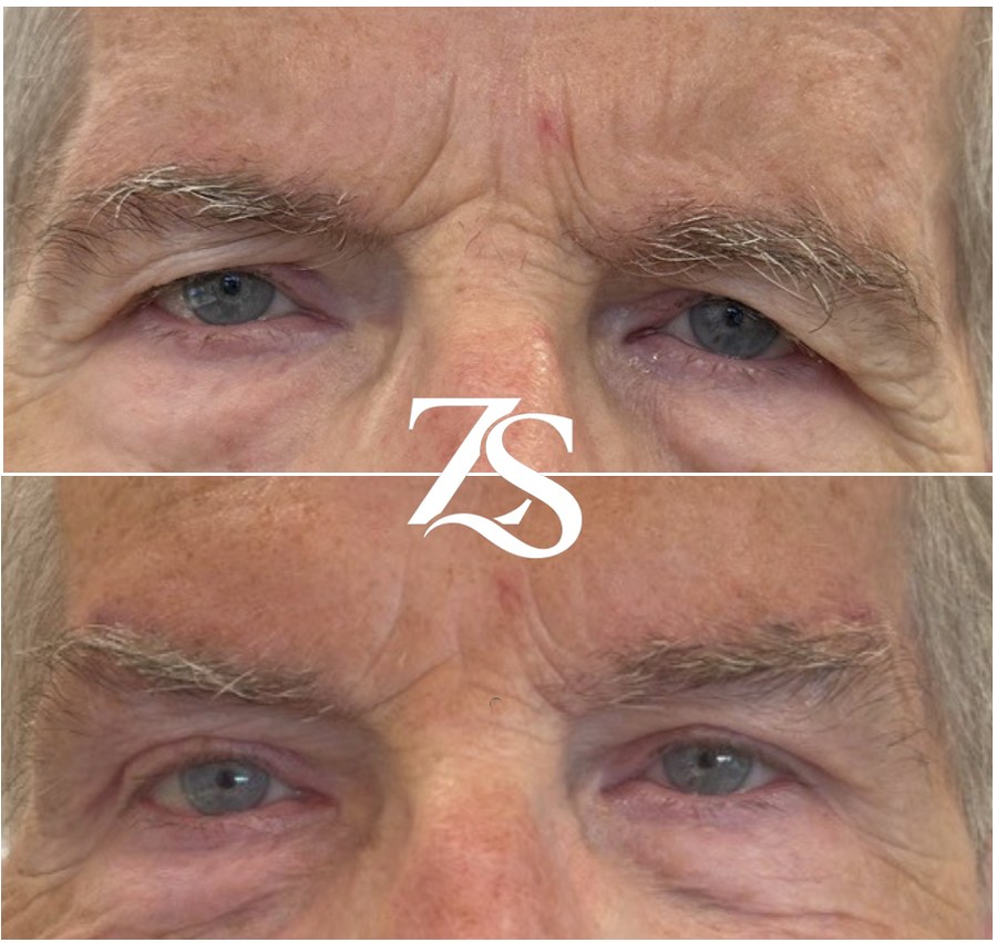 Bilateral Brow Lift and Upper Lid Blepharoplasty