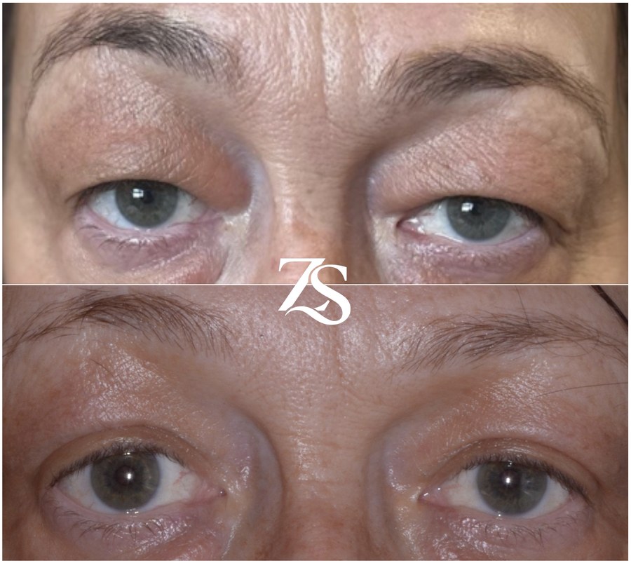 Bilateral Upper Lid Blepharoplasty