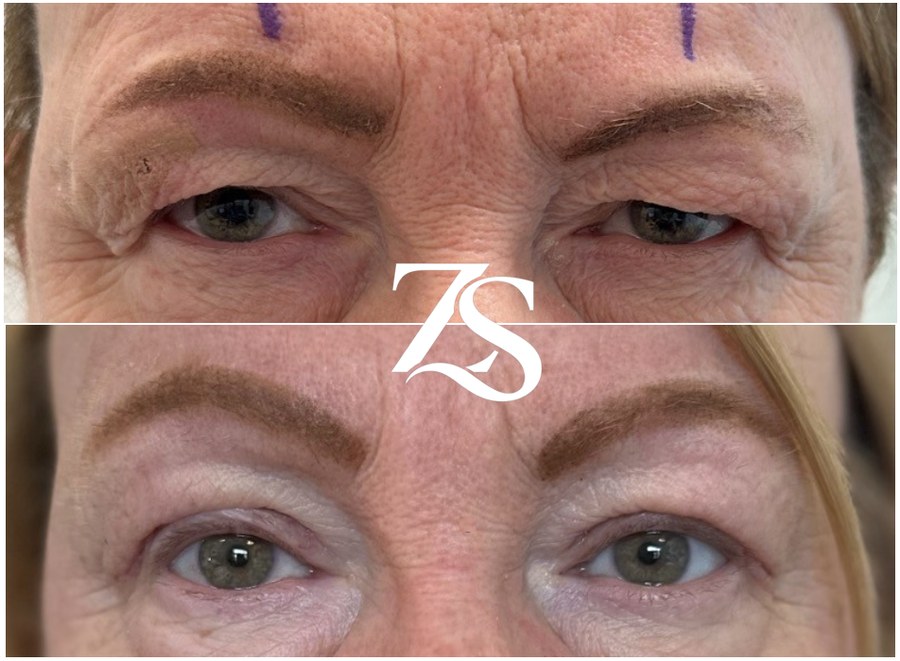 Bilateral Upper Lid Blepharoplasty
