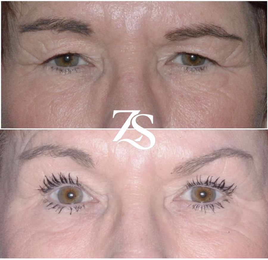 Left Brow Lift and Bilateral Upper Lid Blepharoplasty
