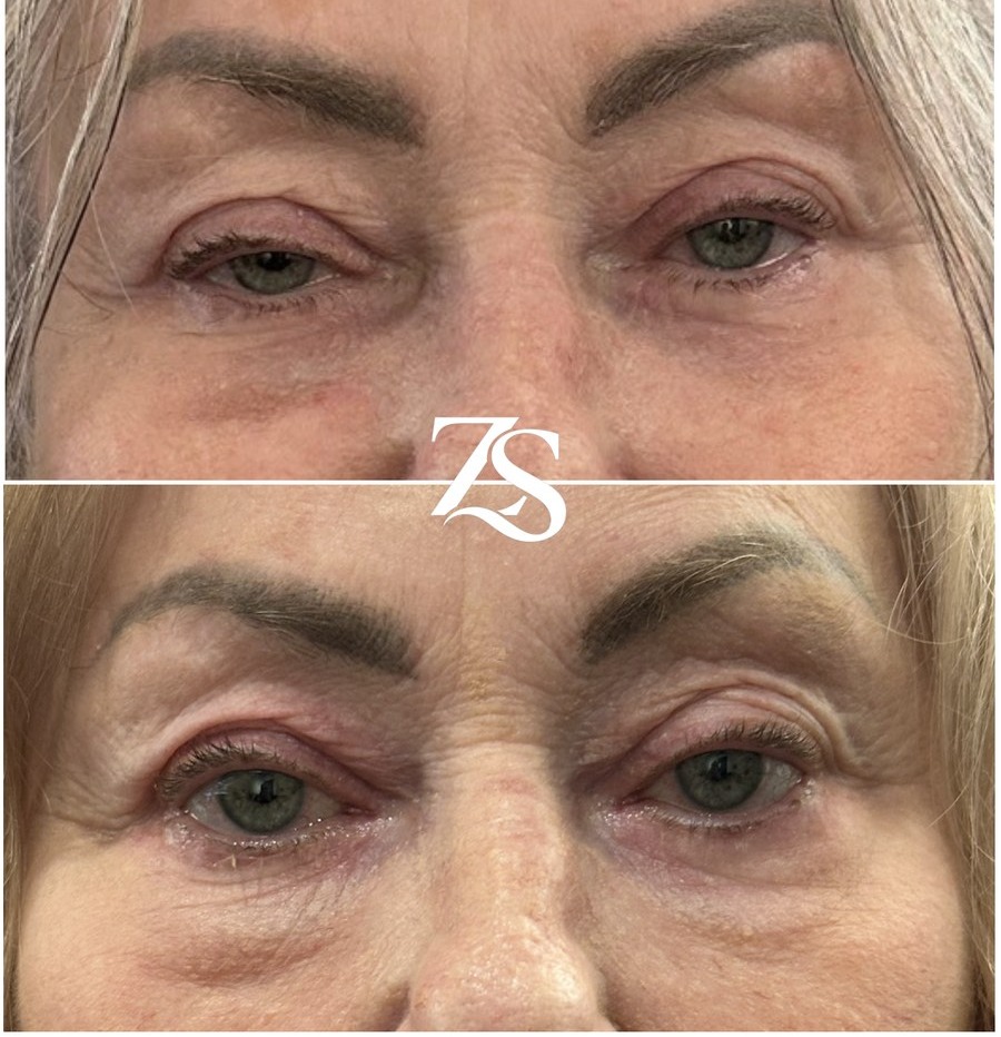 Right Ptosis Surgery