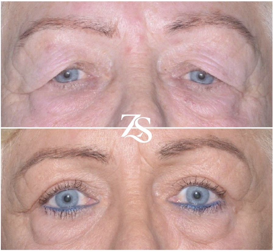 Bilateral Upper Lid Blepharoplasty