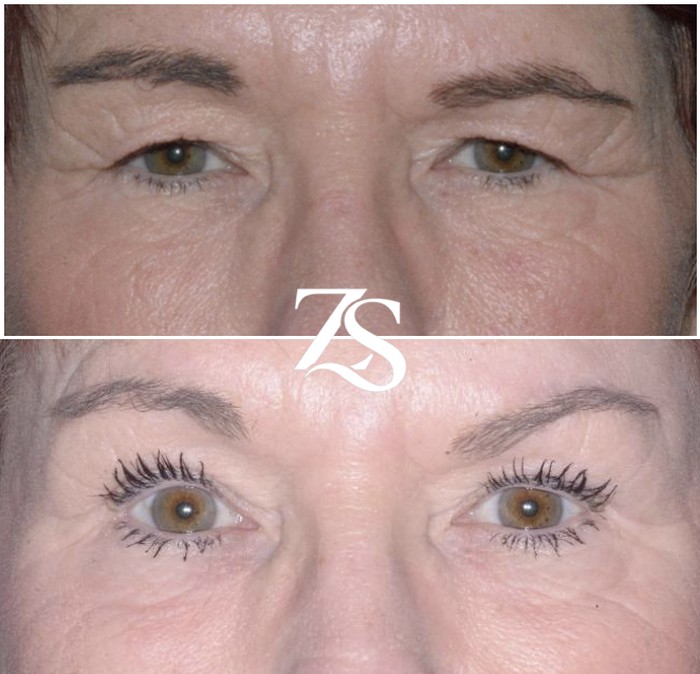 Before and after blepharoplasty