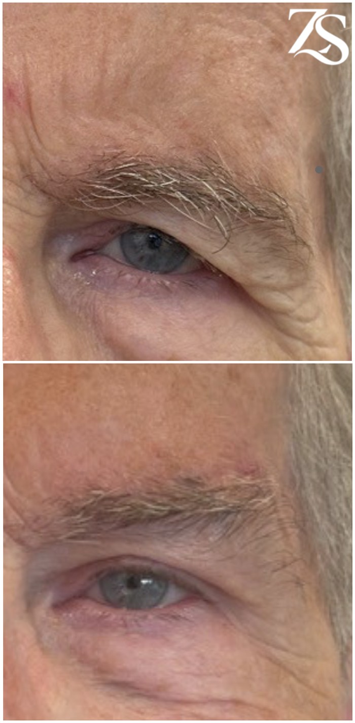 Before and after brow lift, close-up of eyebrow position